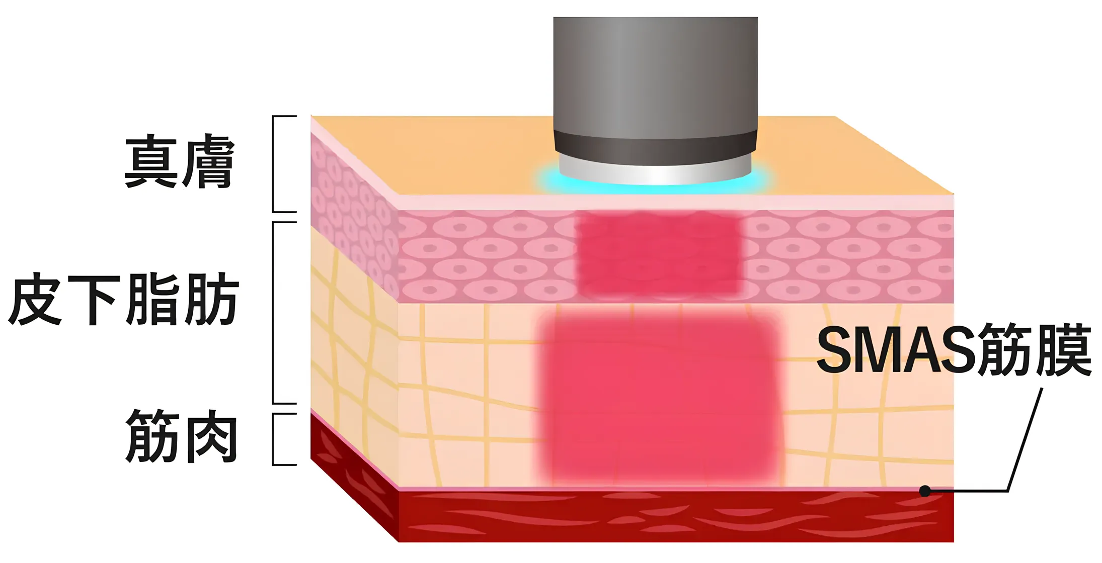 TAクリニックのオンダリフトの施術詳細