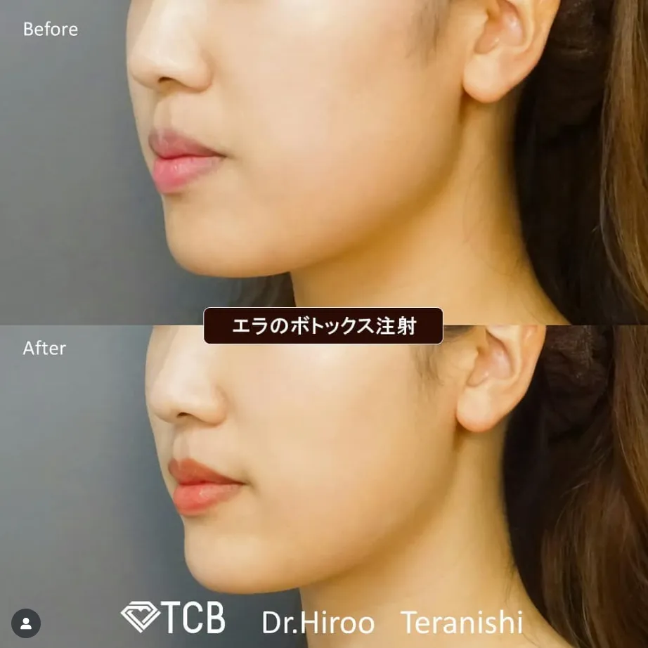 広島でエラボトックスが上手い先生がいると口コミで話題のTCBの症例①