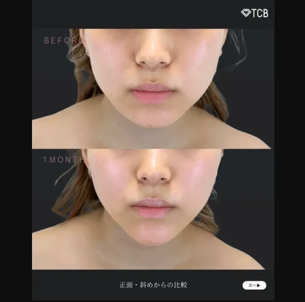 TCBのエラボトックスの症例