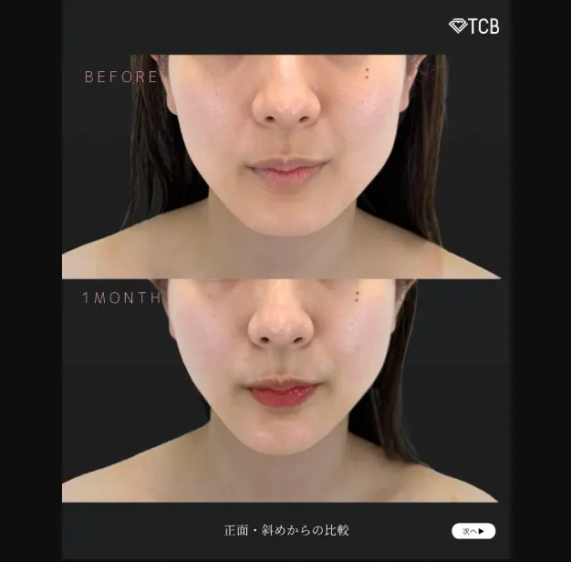 TCBのエラボトックスの症例