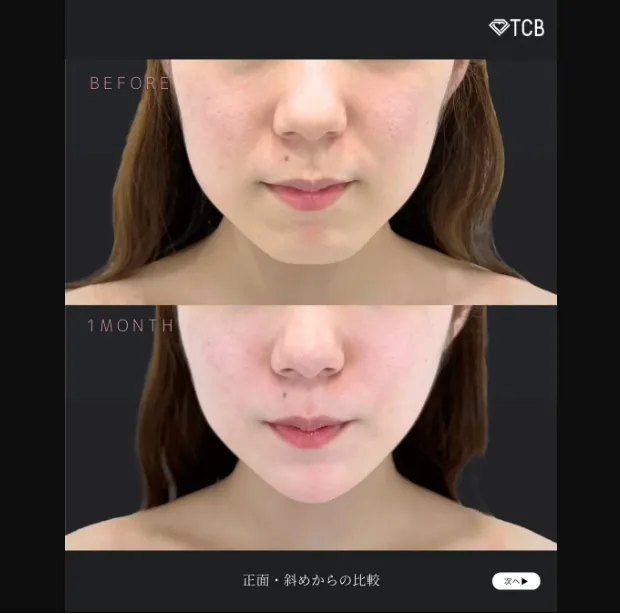 TCBのエラボトックスの症例