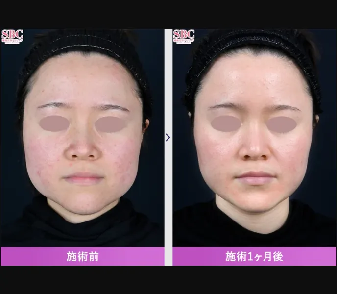 SBCのエラボトックスの症例