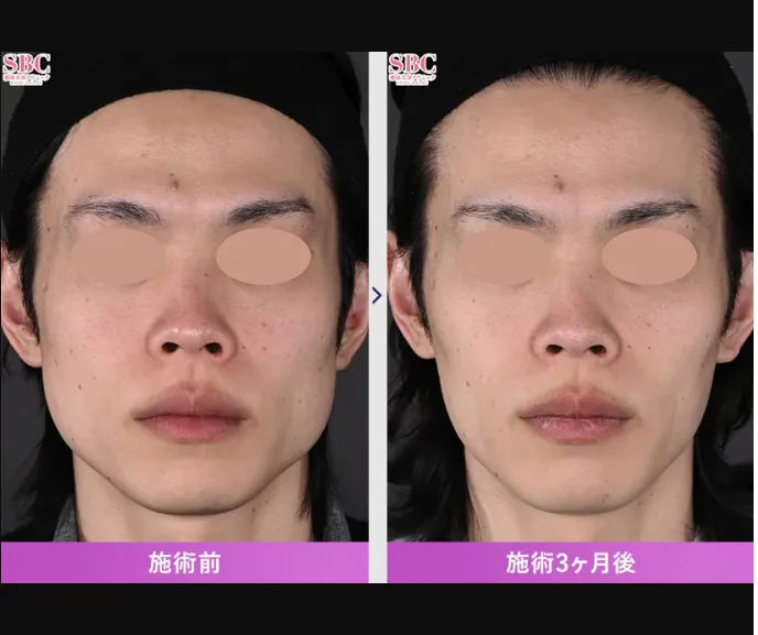 SBCのエラボトックスの症例