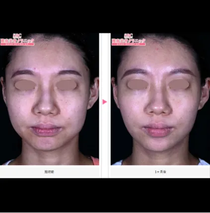 SBCのエラボトックスの症例