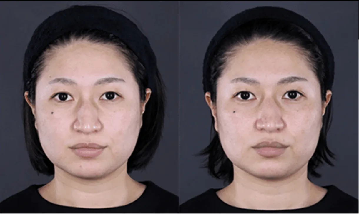 湘南美容クリニックの医療ハイフの症例3