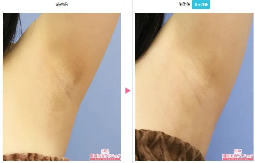 東京で安いミラドライが受けられるおすすめの湘南美容クリニック 症例写真