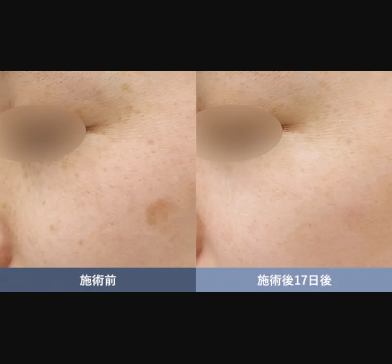 SBCのピコスポットの症例