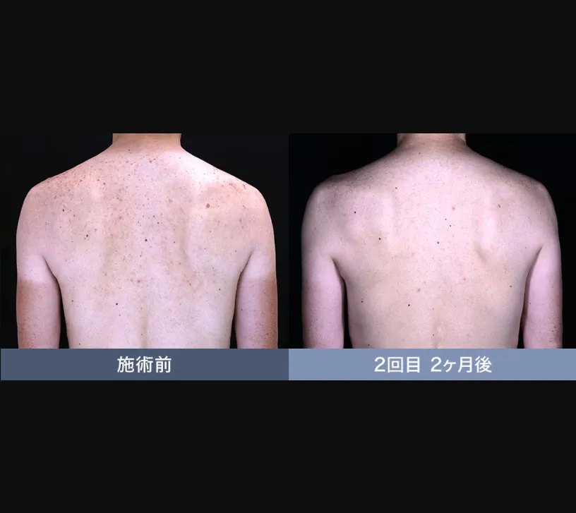 SBCのピコスポットの症例