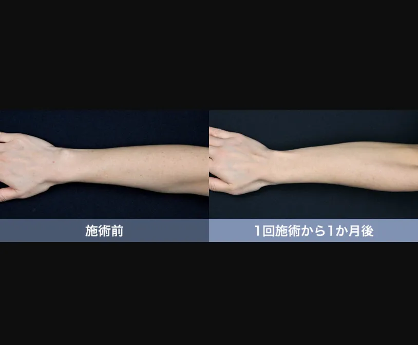 SBCのピコスポットの症例