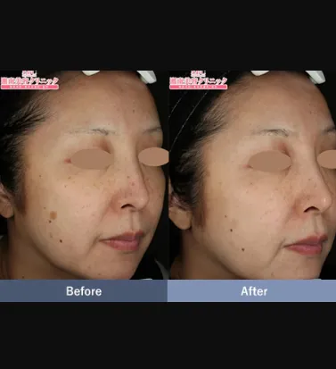 SBCのピコスポットの症例