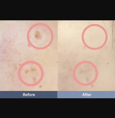 SBCのピコスポットの症例