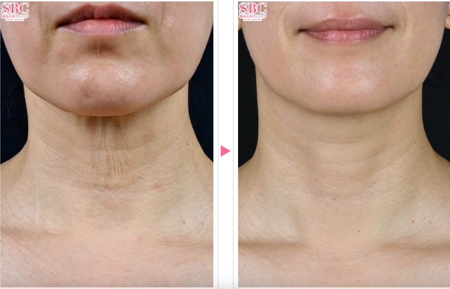 湘南美容クリニックのプロファイロの症例