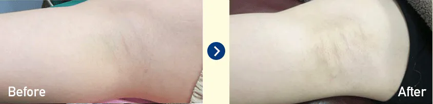 横浜でミラドライが安いおすすめのクリニック 湘南美容クリニックの症例画像