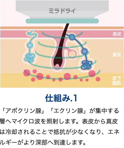 横浜でミラドライが安いおすすめのクリニック 湘南美容クリニックの仕組み画像