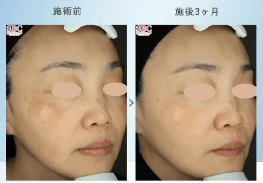 横浜でピコトーニングが安いおすすめのクリニック湘南美容クリニック　症例写真