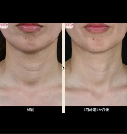 SBCのプロファイロの症例