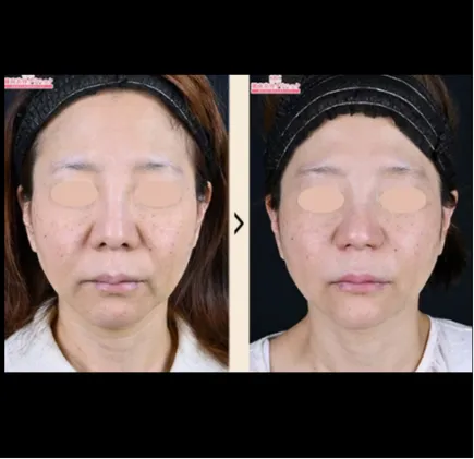 SBCのプロファイロの症例