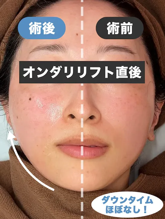 湘南美容クリニックのオンダリフトの症例写真