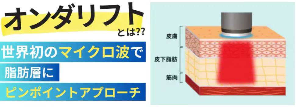 埼玉で安いおすすめの湘南美容クリニックのオンダリフトの仕組みについて