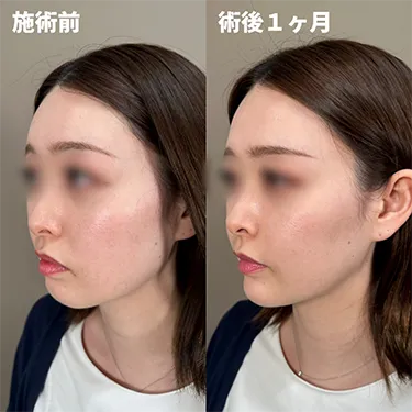 TCBの糸リフトの症例