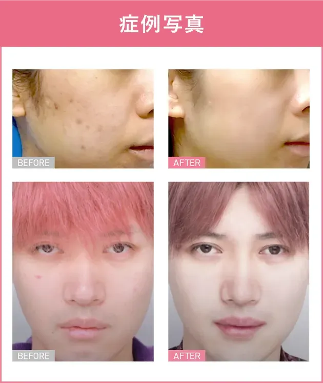 TCBのサブシジョンの症例写真