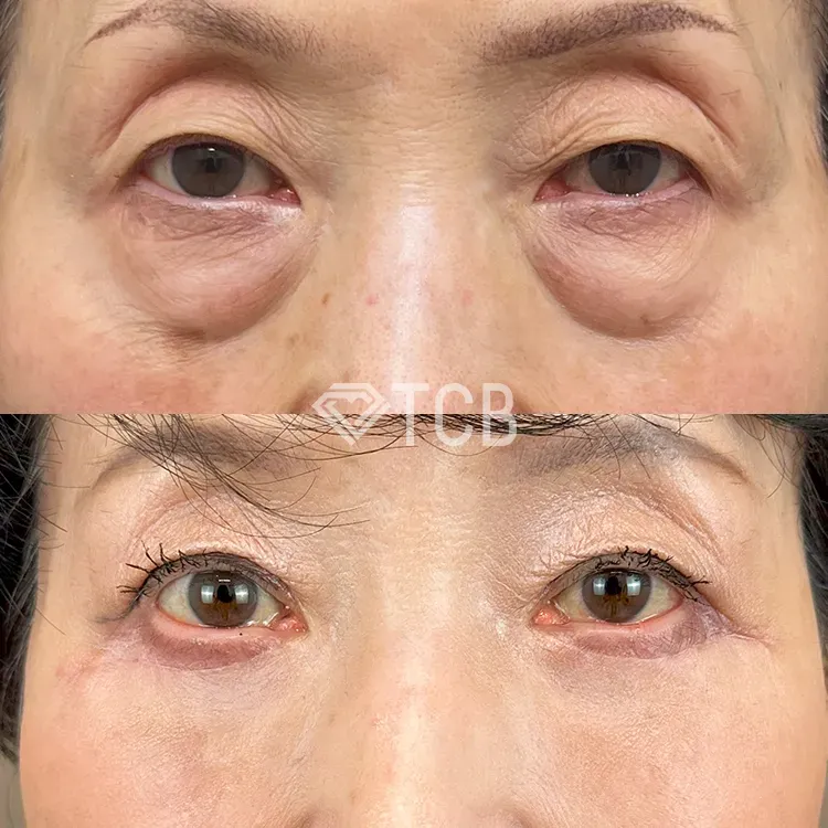 TCBのクマ取り施術の症例写真