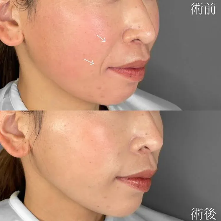 TCBの糸リフトの症例