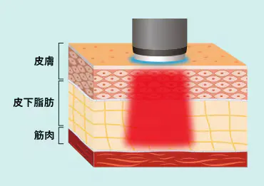 千葉でオンダリフトが安いおすすめのクリニック　湘南美容クリニックのLP画像　オンダリフトの詳細