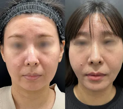 勘定正哉医師の小顔瘦身の症例