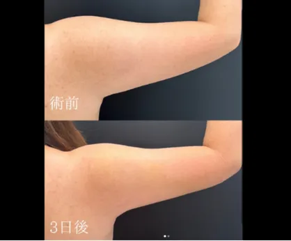 勘定正哉医師の脂肪吸引の症例