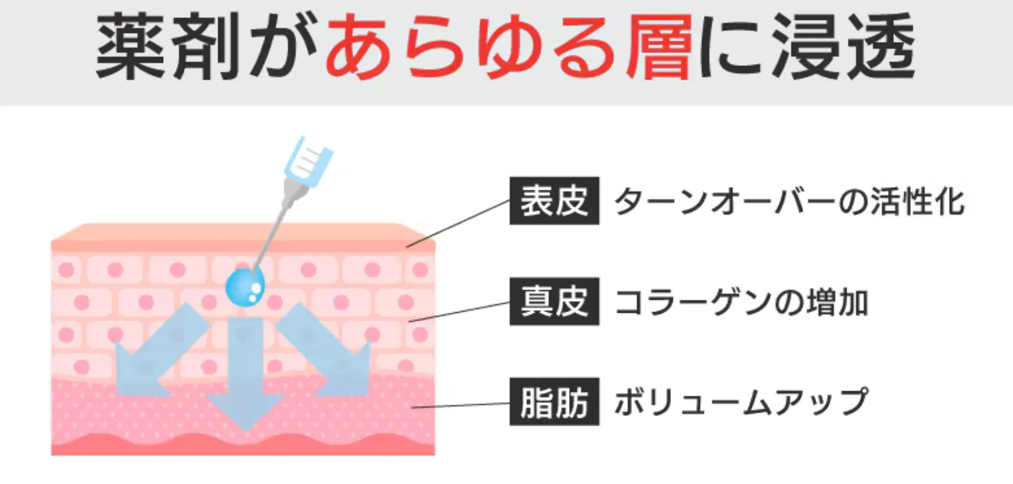 福岡で安いプロファイロがおすすめの湘南美容クリニック 施術解説