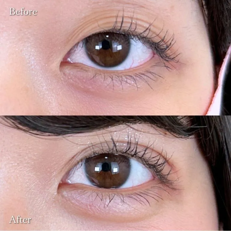 TCBの二重整形の症例