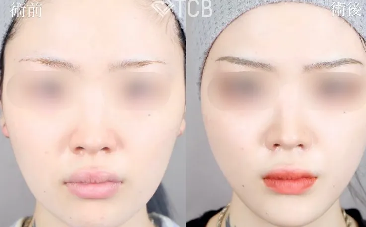 TCBの糸リフトの症例写真