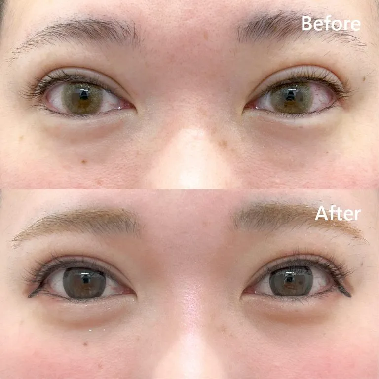 TCBのクマ取り再生注射の症例