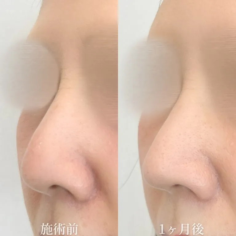 TCBの鼻尖形成の症例