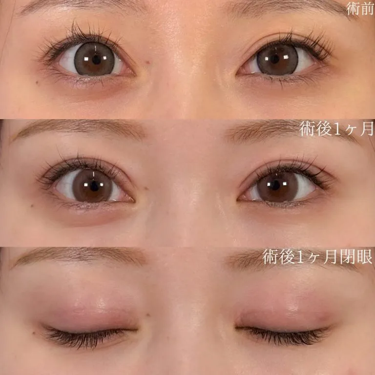 TCBの二重整形の症例