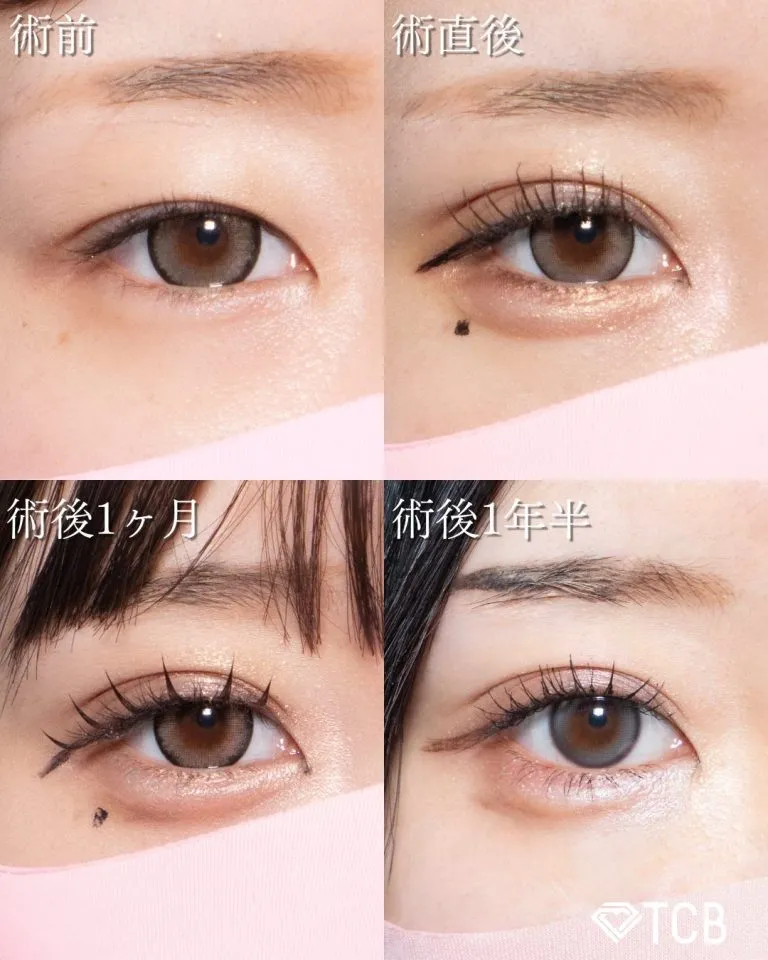 TCBの二重整形の症例