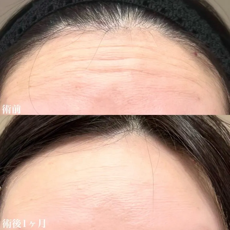 TCBのボトックスの症例