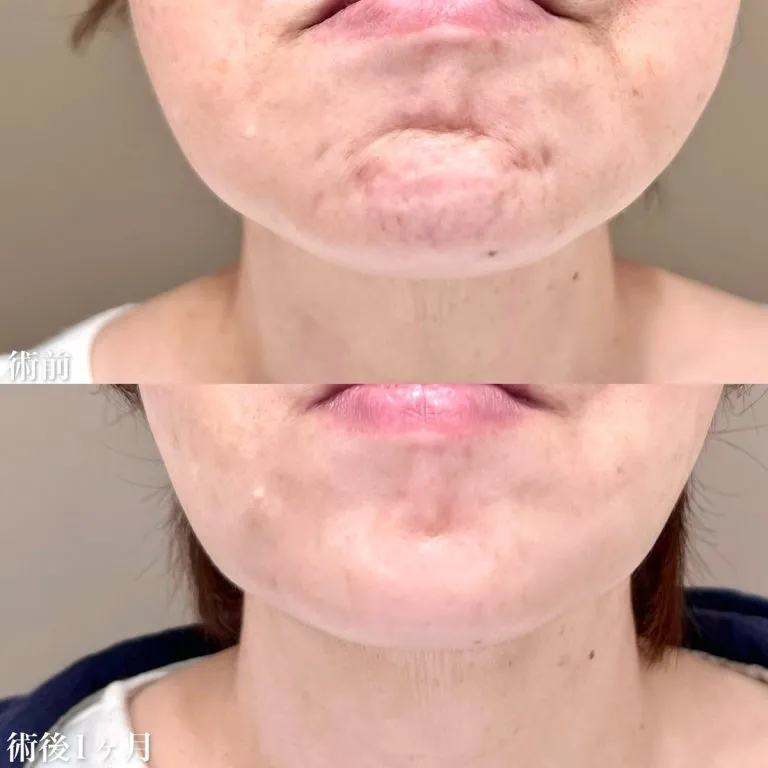 TCBのボトックスの症例