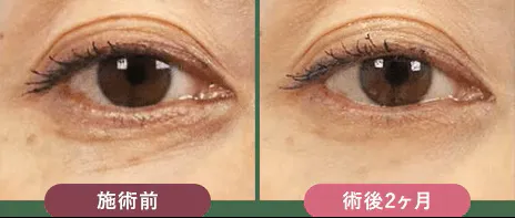 大宮でリジュラン注射が安いおすすめクリニックの湘南美容クリニックの症例写真