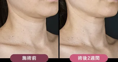 東京でリジュラン注射が安いおすすめの湘南美容クリニック 症例写真2