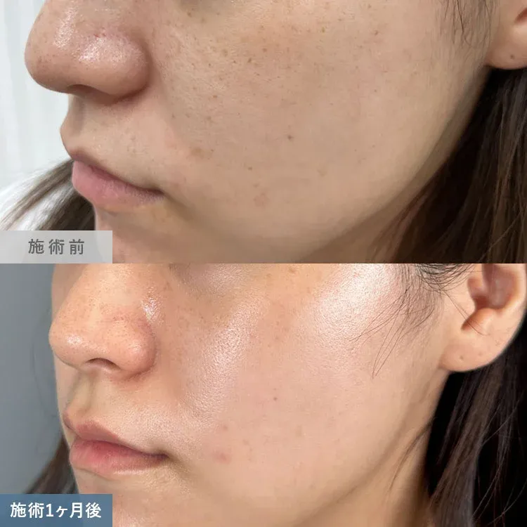 TCBのピコレーザーの症例