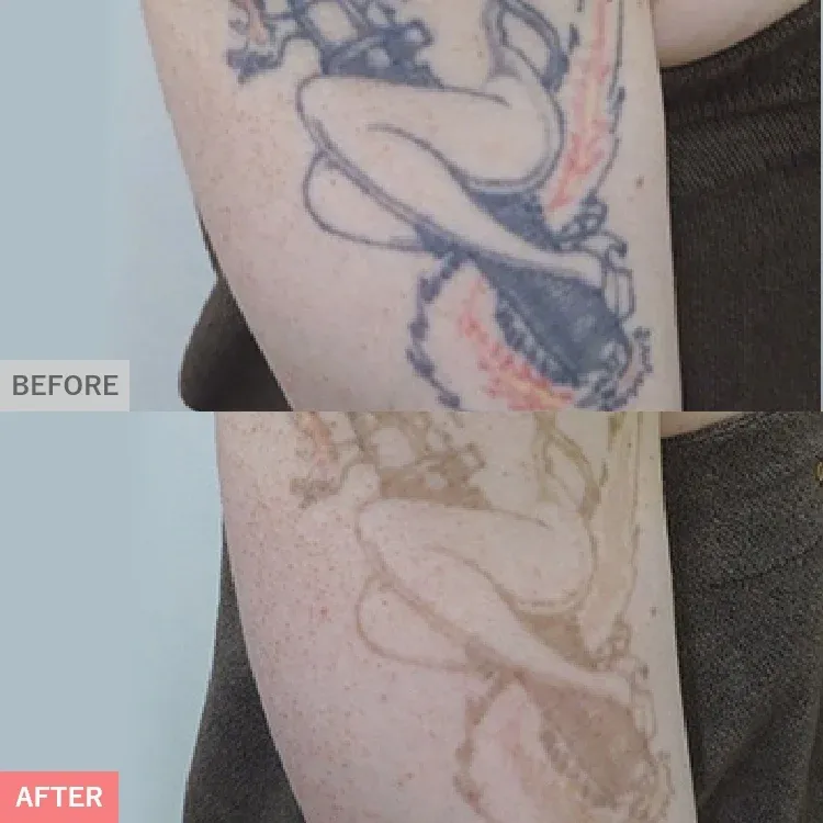 TCBのピコレーザーの症例