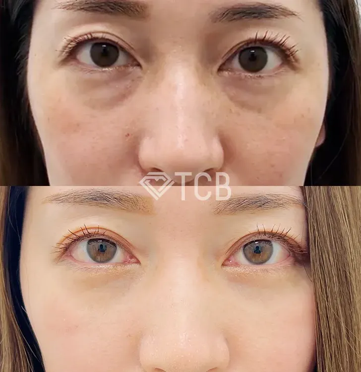 高田馬場でおすすめのTCBのクマ取り症例写真