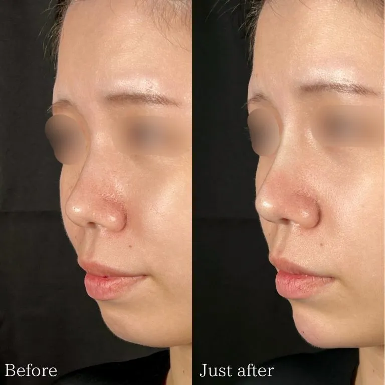 TCBのTCBメッシュの症例