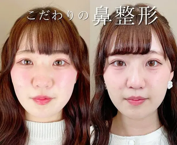 TCBは14万件以上の症例があり、理想とする鼻筋が見つけやすい