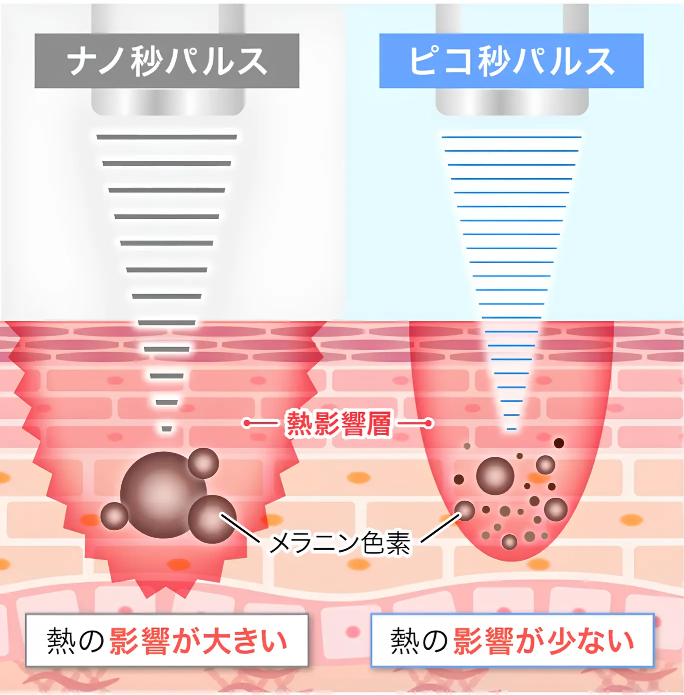 TCBのピコレーザーライト•スタンダードの施術詳細
