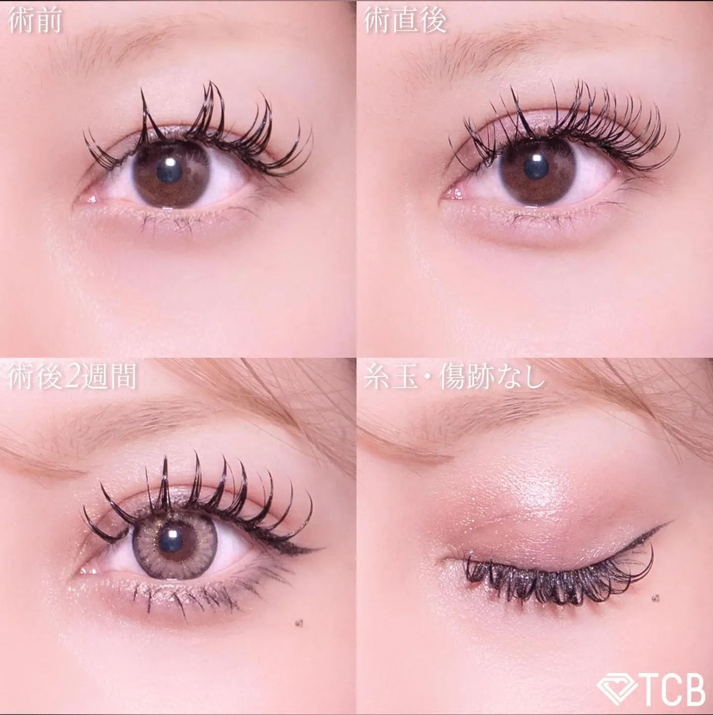 高柳先生の二重整形症例写真