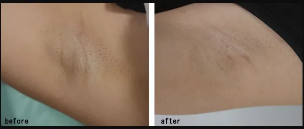 共立美容外科のミラドライの症例写真