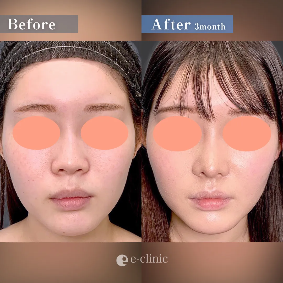 広島で鼻整形がおすすめのeクリニック　症例写真